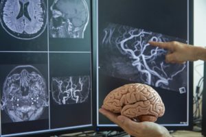 Brain Injury Lawyers in San Jose California